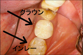 セラミック症例