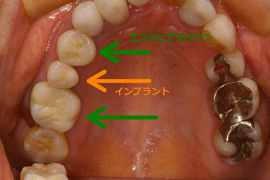 セラミック症例