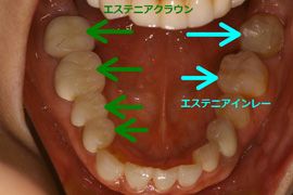 セラミック症例