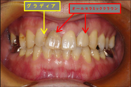セラミック症例