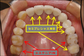 セラミック症例