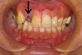 インプラント症例