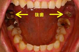 インプラント症例
