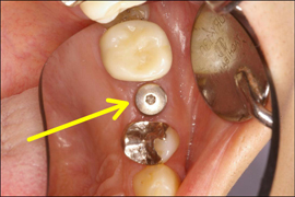 インプラント症例