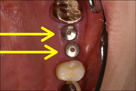 インプラント症例
