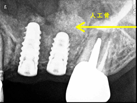 インプラント症例