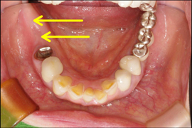 インプラント症例