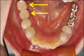 インプラント症例