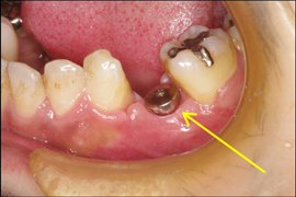 インプラント症例