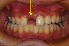 インプラント症例