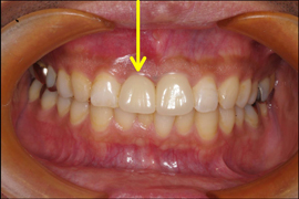インプラント症例