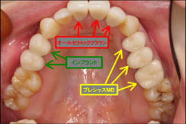 インプラント症例