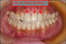 インプラント症例