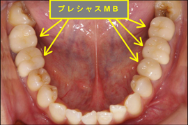 インプラント症例