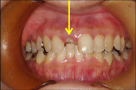 インプラント症例