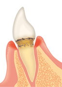 歯周病の進行について