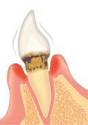 歯周病の進行について